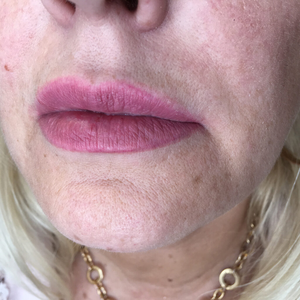 sosudistaja kozha go permanentnogo