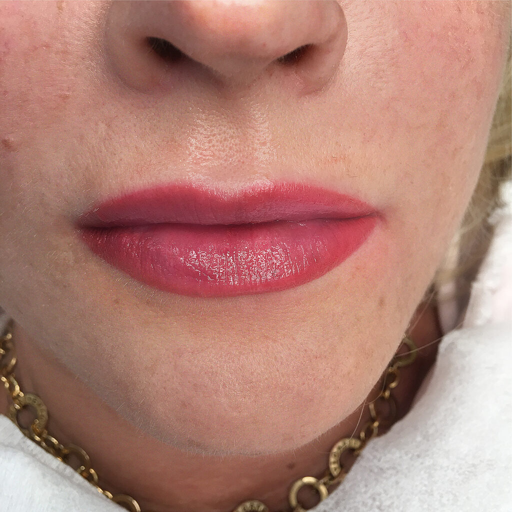 Stabilizacja pigmentu przy skórze z trądzikiem różowatym - makijaz permanentny trądzik rózowaty 