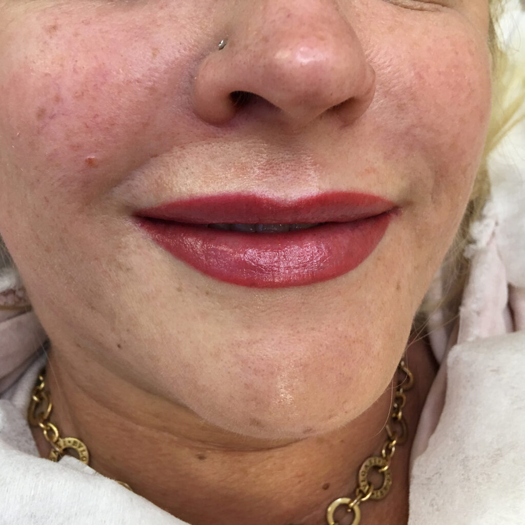 Stabilizacja pigmentu przy skórze z trądzikiem różowatym makijaz permanentny trądzik rózowaty 