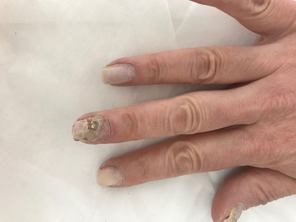 Может ли гель лак провоцировать грибок ногтей?
