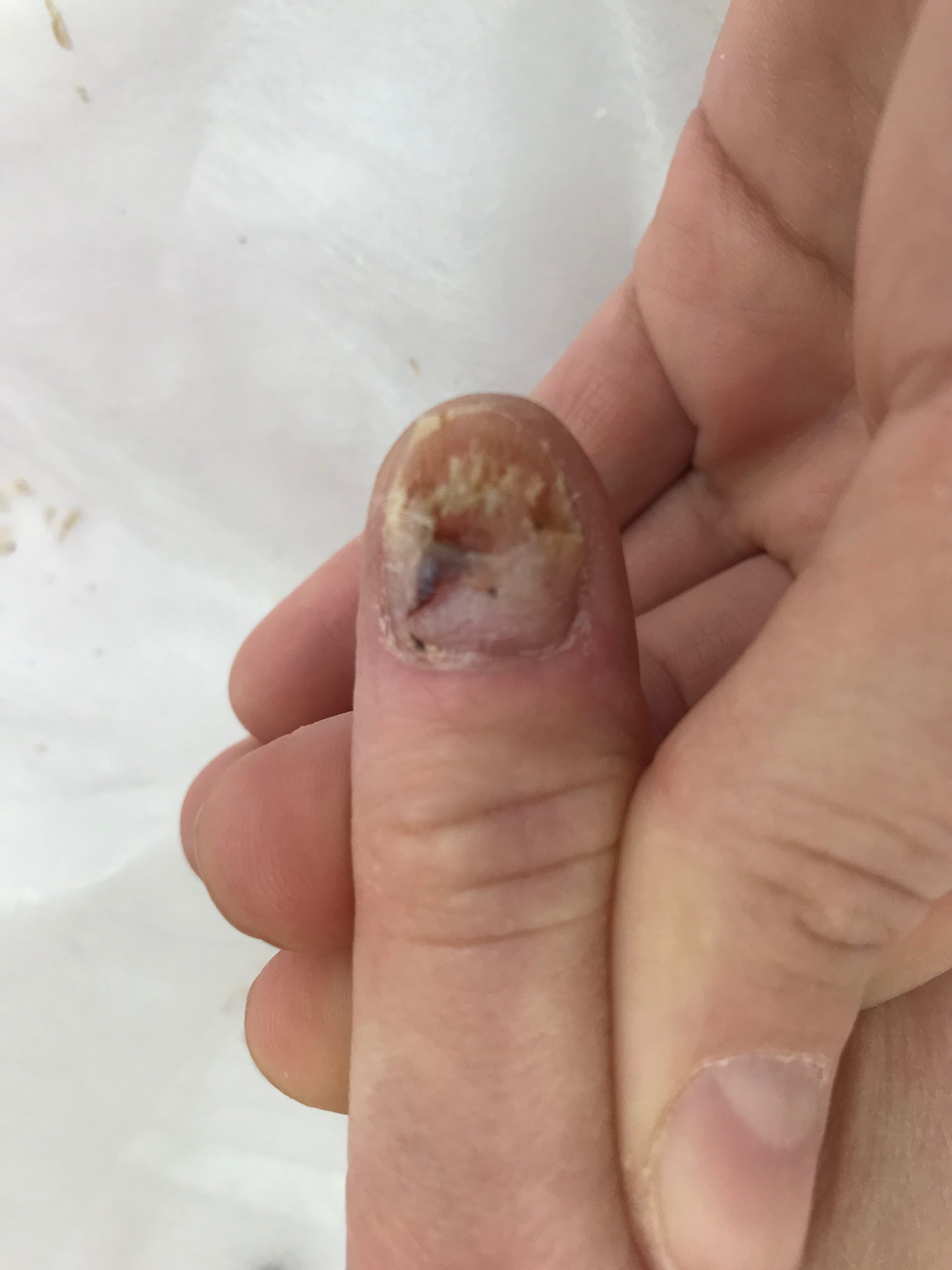 Причины возникновения грибка на ногтях
