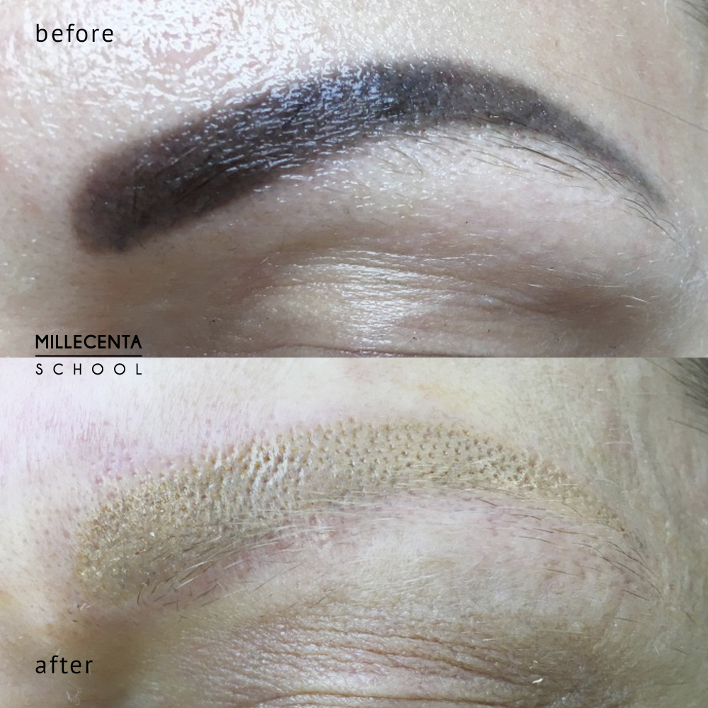 Удаление перманентного макияжа ремувером фото до и после