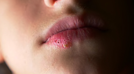 HERPES AND PERMANENT MAKEUP