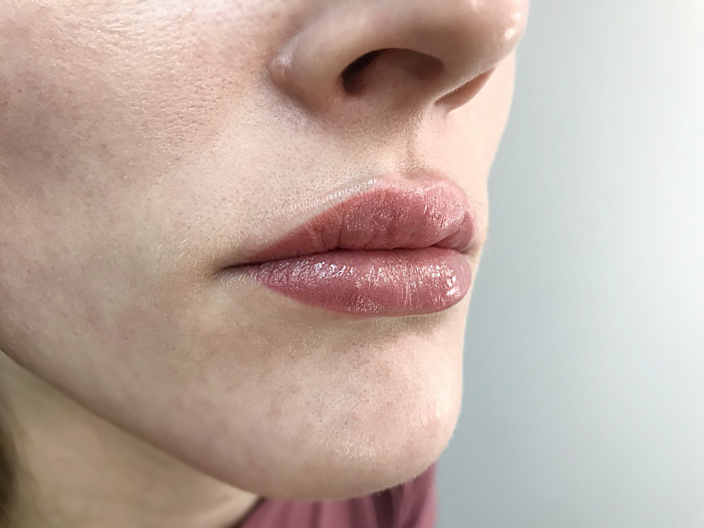  lip defect correction
