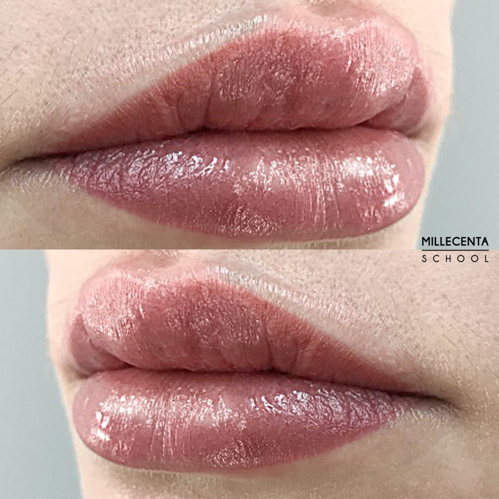  lip defect correction