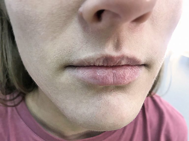 Fordyce granules Перманентный макияж