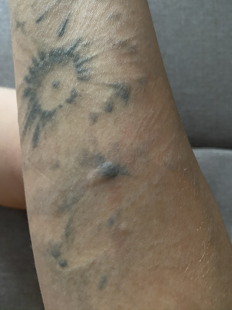 Red Scaly Rash Following Tattoo Application | MDedge Dermatology