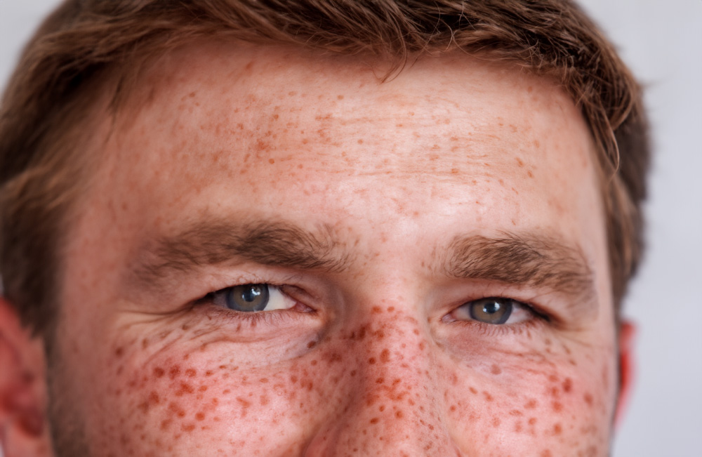 Removal of freckles after permanent makeup - Usuwanie piegów za pomocą lasera
