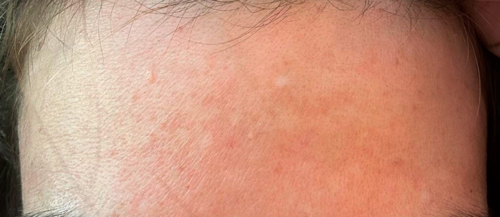 Пигментация после IPL