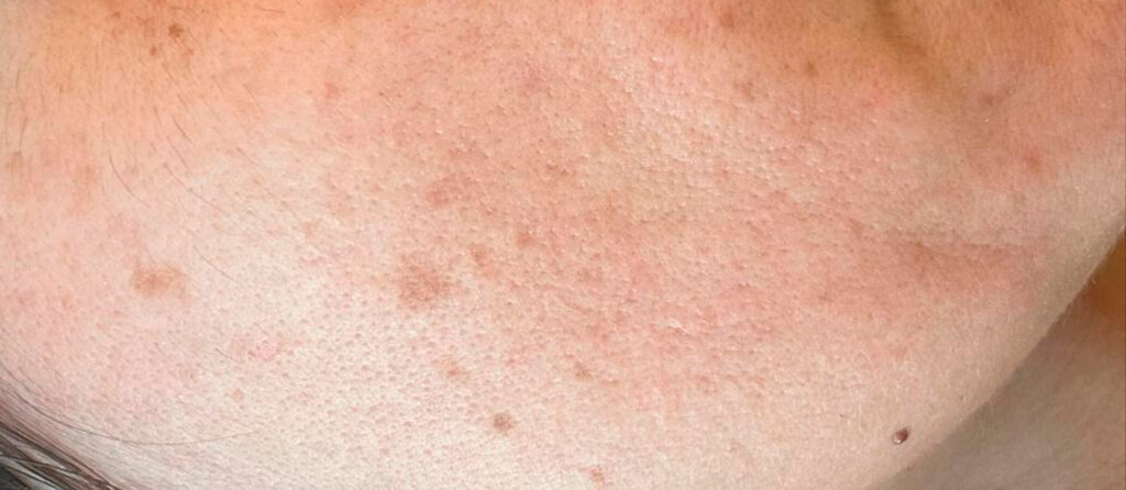 Пигментация после IPL: почему возникает и как безопасно уменьшить | Врачебный разбор + протокол ухода Пигментация после IPL