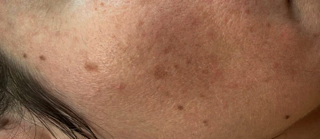 Гиперпигментация скулы/виска через 12 месяцев после IPL Пигментация после IPL