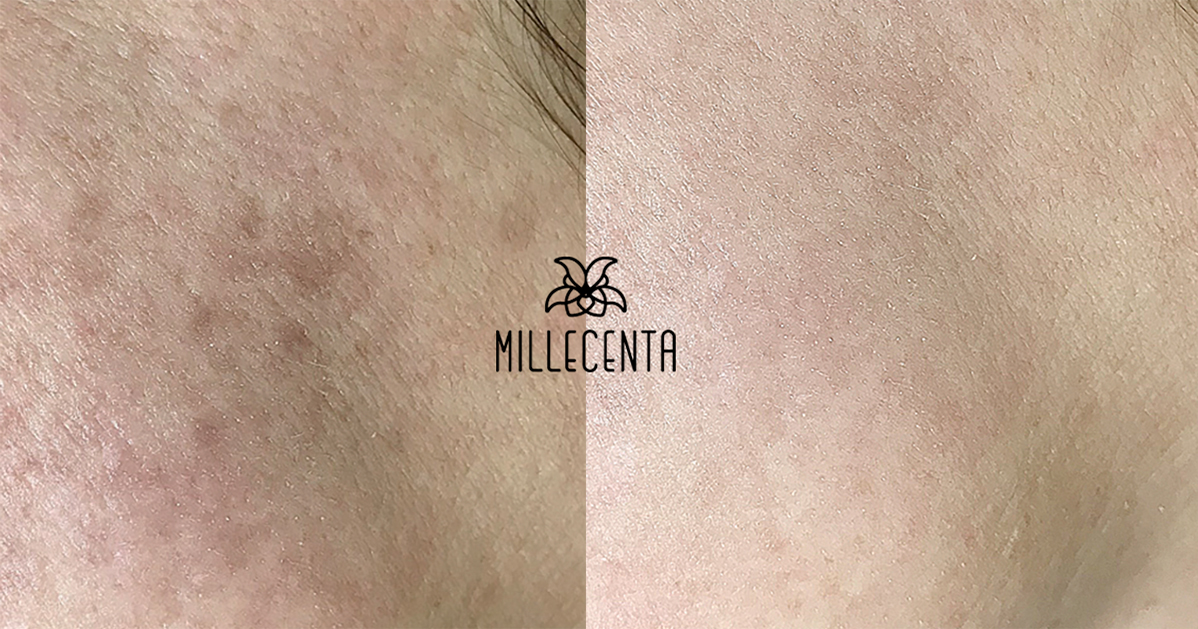 пигментация после лазера IPL