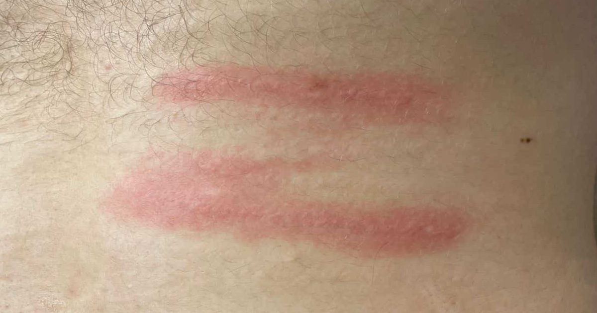 Аллергия и камуфляж растяжки